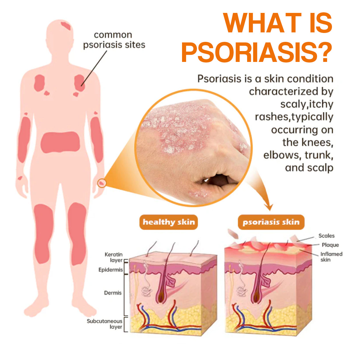 ✨【 official  Brand  Store】  Last Day Discount: 83% OFF 🌸 Seurico™ PsoriaHeal  psoriasis Spray pro