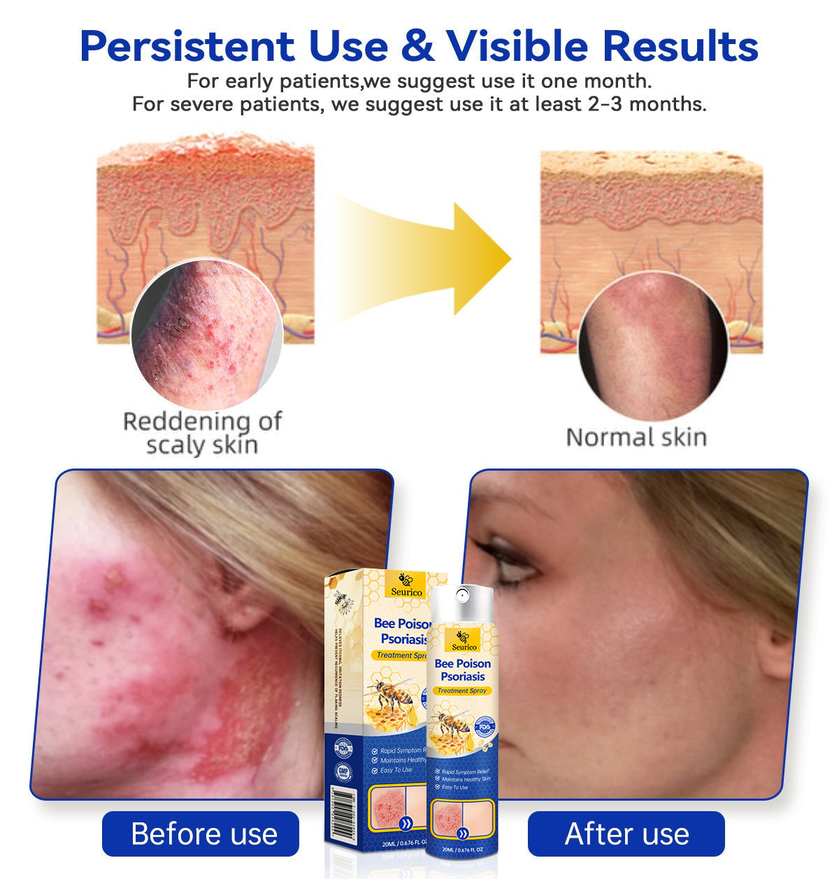✨【 official  Brand  Store】  Last Day Discount: 83% OFF 🌸 Seurico™ PsoriaHeal  psoriasis Spray pro