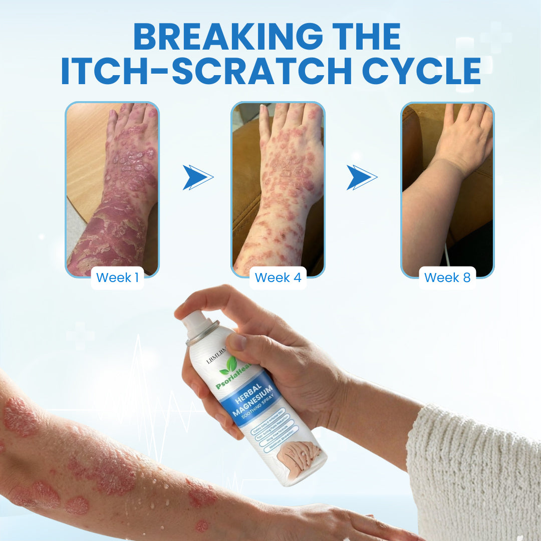 🌿LBMLBM™ PsoriaHeal Herbal Magnesium Soothing Spray⭐