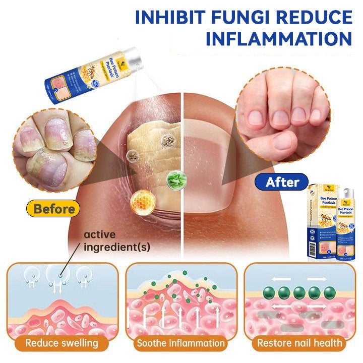 ✨【 official  Brand  Store】  Last Day Discount: 83% OFF 🌸 Seurico™ PsoriaHeal  psoriasis Spray pro