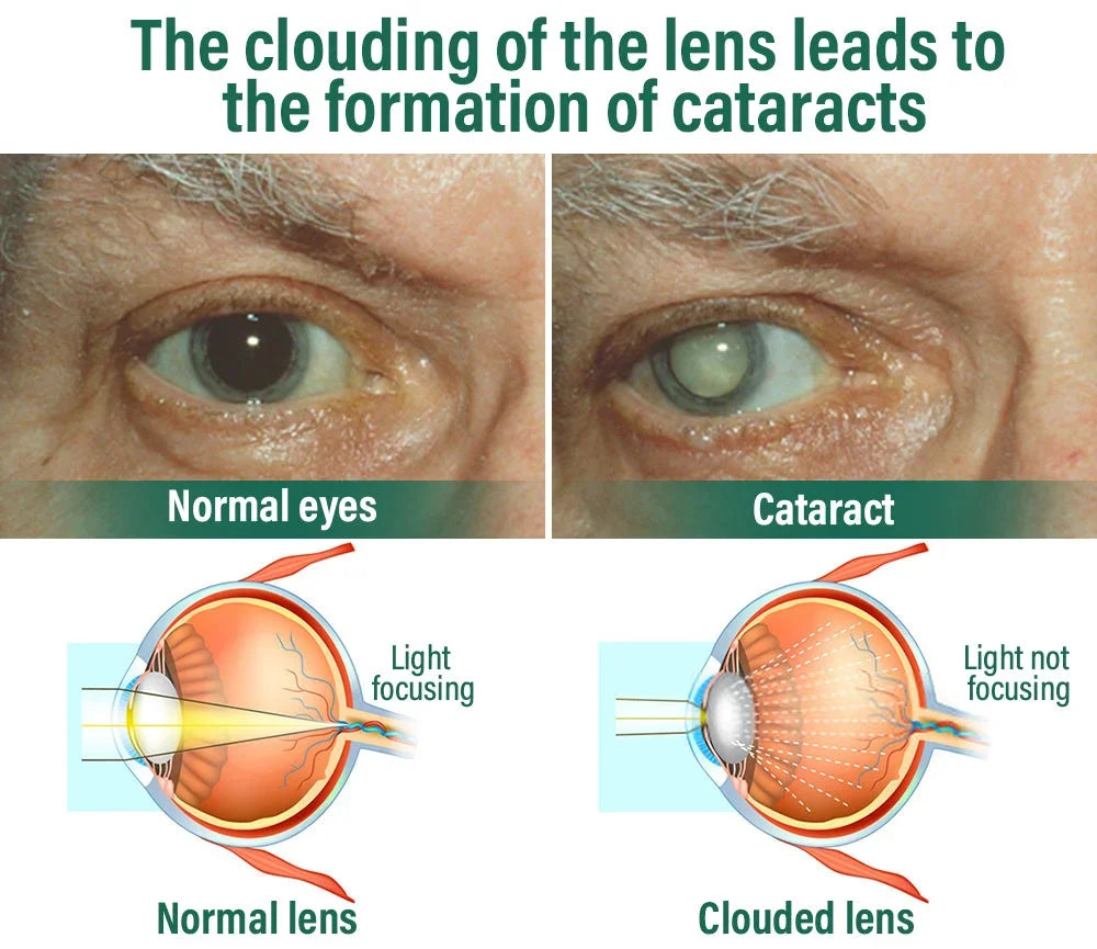 NEGUSY™ Nano Vision Repair Eye Serum ✅FDA Approved(Suitable for presbyopia, dry eye syndrome, glaucoma, and cataracts)